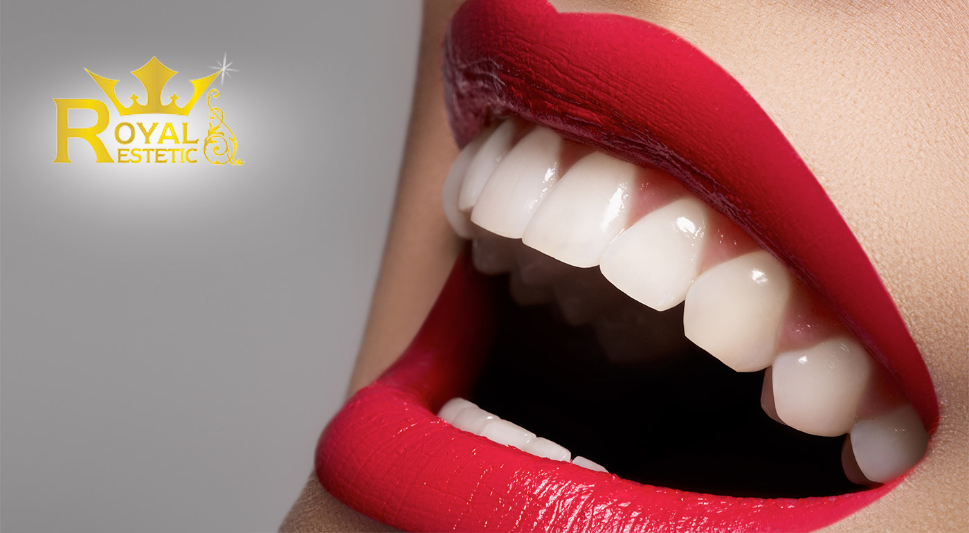 Krásny úsmev pre krásny deň - bezperoxidové bielenie zubov v Royal estetic