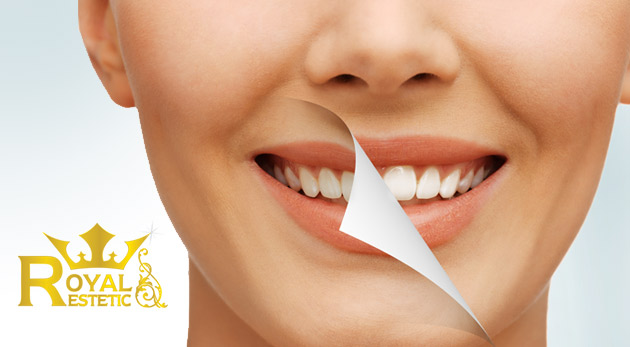 Bezperoxidové bielenie zubov v Royal estetic - urobte radosť vašim nádherným úsmevom každému naokolo
